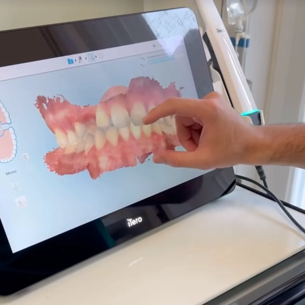 Scansione digitale delle arcate sullo schermo dello scanner intraorale iTero