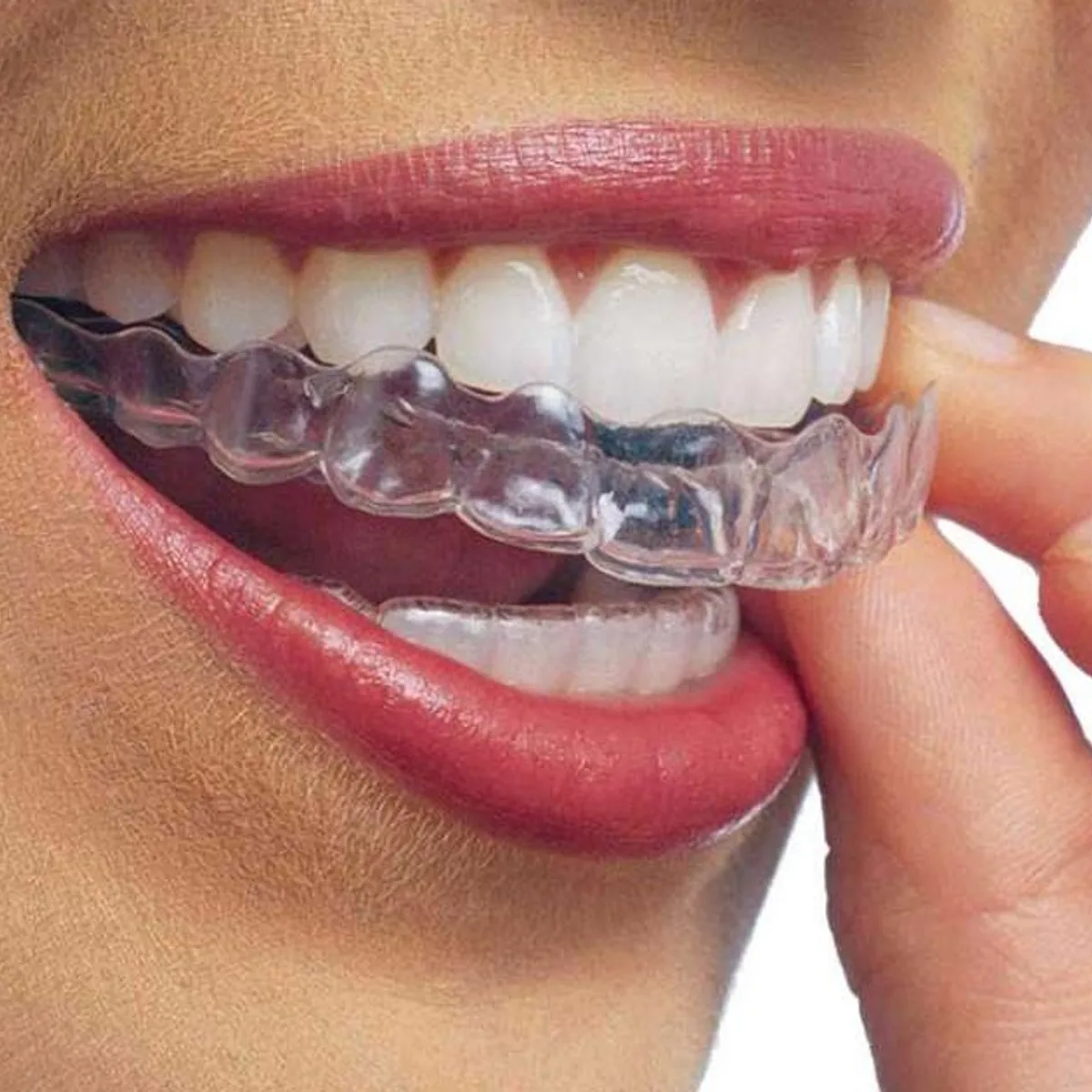 Allineatore trasparente Invisalign applicato sull'arcata superiore